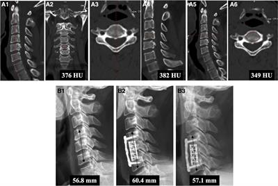 The predictive value of Hounsfield units for titanium mesh cage subsidence after anterior cervical corpectomy and fusion